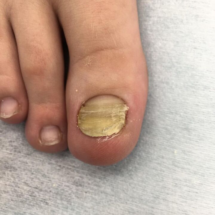 fungus infection