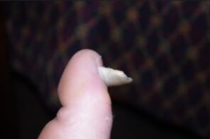Fungus symptoms in nails