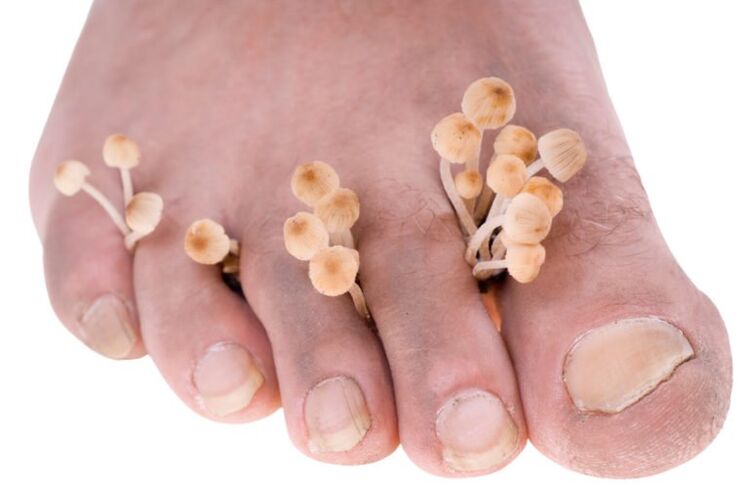 fungus in legs symptoms