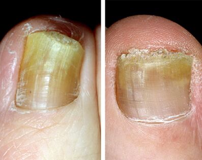 Distal form of onychomycosis in the legs