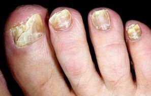 nail fungus symptoms