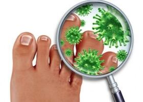 toenail fungus treatment methods