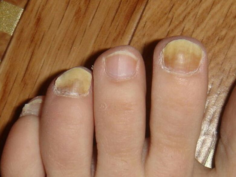 fungal infection of toenails