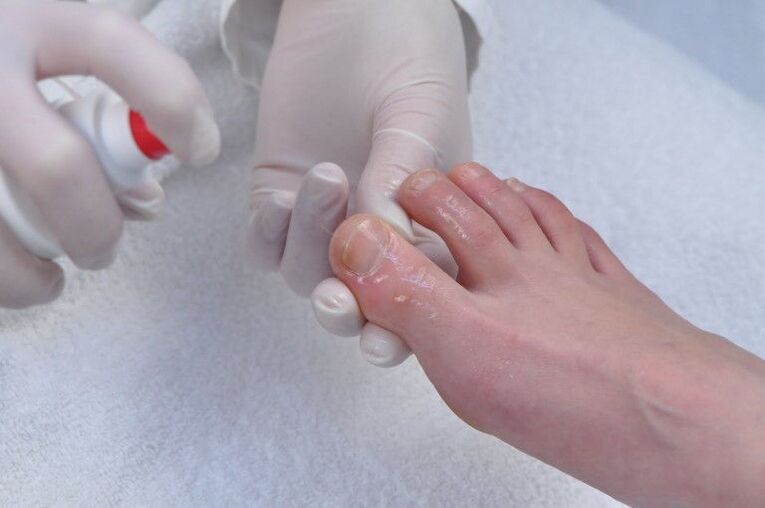 nail plate treatment for fungal infection
