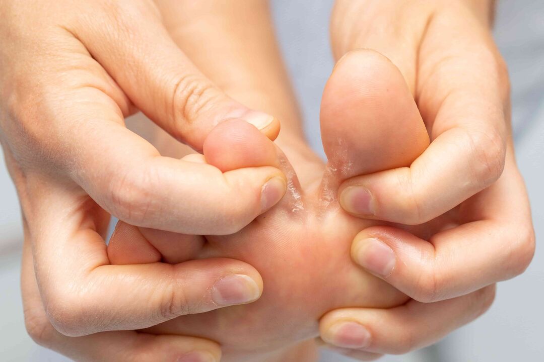 fungus between the toes and its treatment with the Demyxil Cream